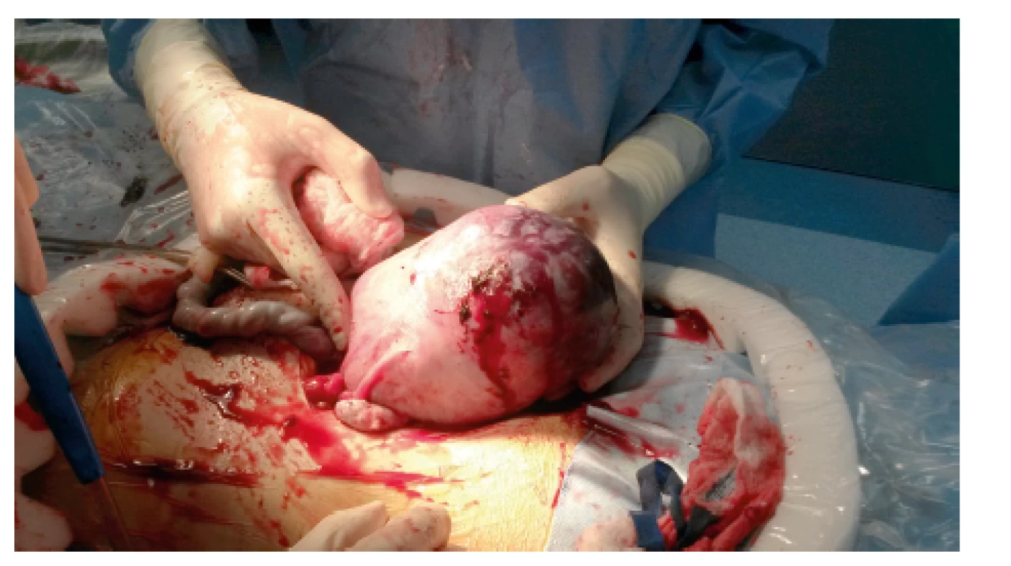 Ruptura dělohy u pacientky ve 36. týdnu gravidity
s anamnézou perforace děložního fundu během operační
hysteroskopie