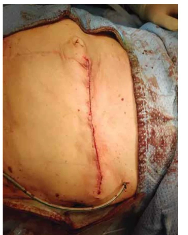 Uzavřená břišní stěna po operačním výkonu.<br>
Fig. 4. Closed abdominal wall after surgery.