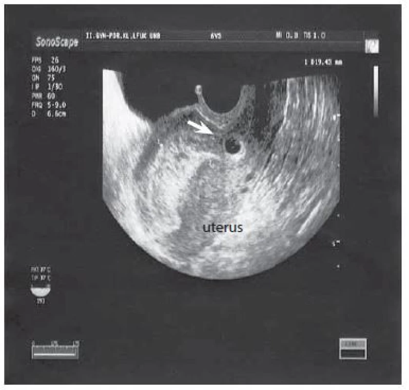 Dutina uteru s gestačným vakom a vitálnym embryom (šípka) v mieste jazvy po cisárskom reze, foto autori. </br> Uterine cavity with the gestational sac and a vital embryo
(arrow) at the scar site after a caesarean section, photo by the authors.