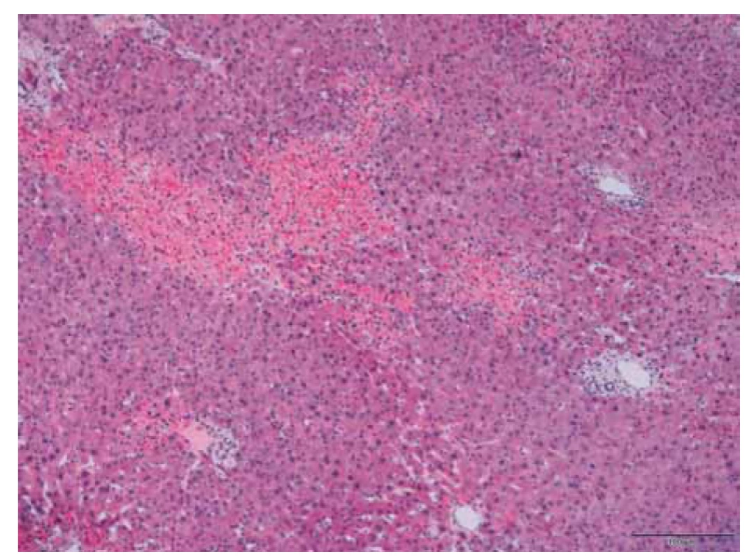 Jaterní tkáň s nepravidelně distribuovanými nekrózami.<br>
Fig. 2. Liver tissue with irregularly distributed necrosis.