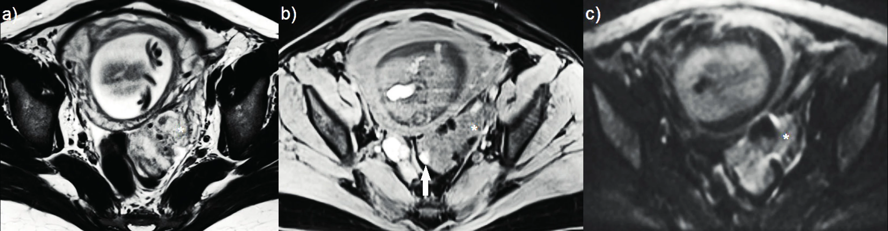 Zobrazení magnetickou rezonancí<br>
(a–c) nodulus hluboké infiltrující endometriózy postihující sigmoideum, diagnostikovaný v graviditě se známkami decidualizace; (a) T2
vážený obraz – ložisko sníženého signálu s hyposignálními okrsky (hvězdička); (b) T1 vážený obraz s potlačením tuku – ložisko izosignální
s endometriem v dutině děložní (hvězdička), hypersignální okrsek odpovídá přítomnosti rozpadových produktů hemoglobinu (šipka);
(c) difuzně vážená sekvence – absence restrikce difuze uvnitř léze (hvězdička).