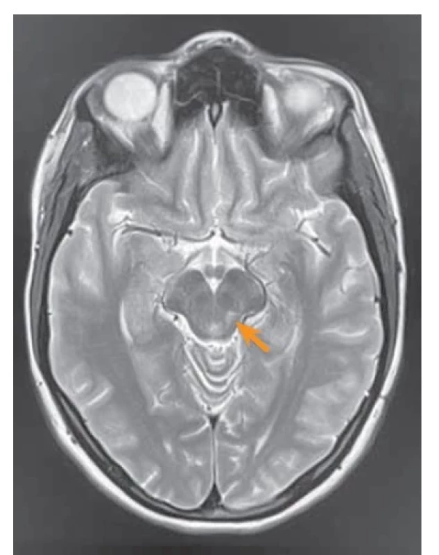 Ložisko gliózy vlevo v oblasti
horního mezencefala.<br>
Fig. 1. On the left, a focus of gliosis
in the upper mesencephalon area.
