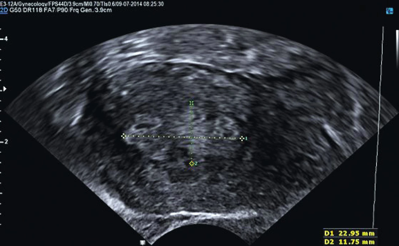 Karcinom děložního těla s povrchovou invazí do
myometria (FIGO IA)
