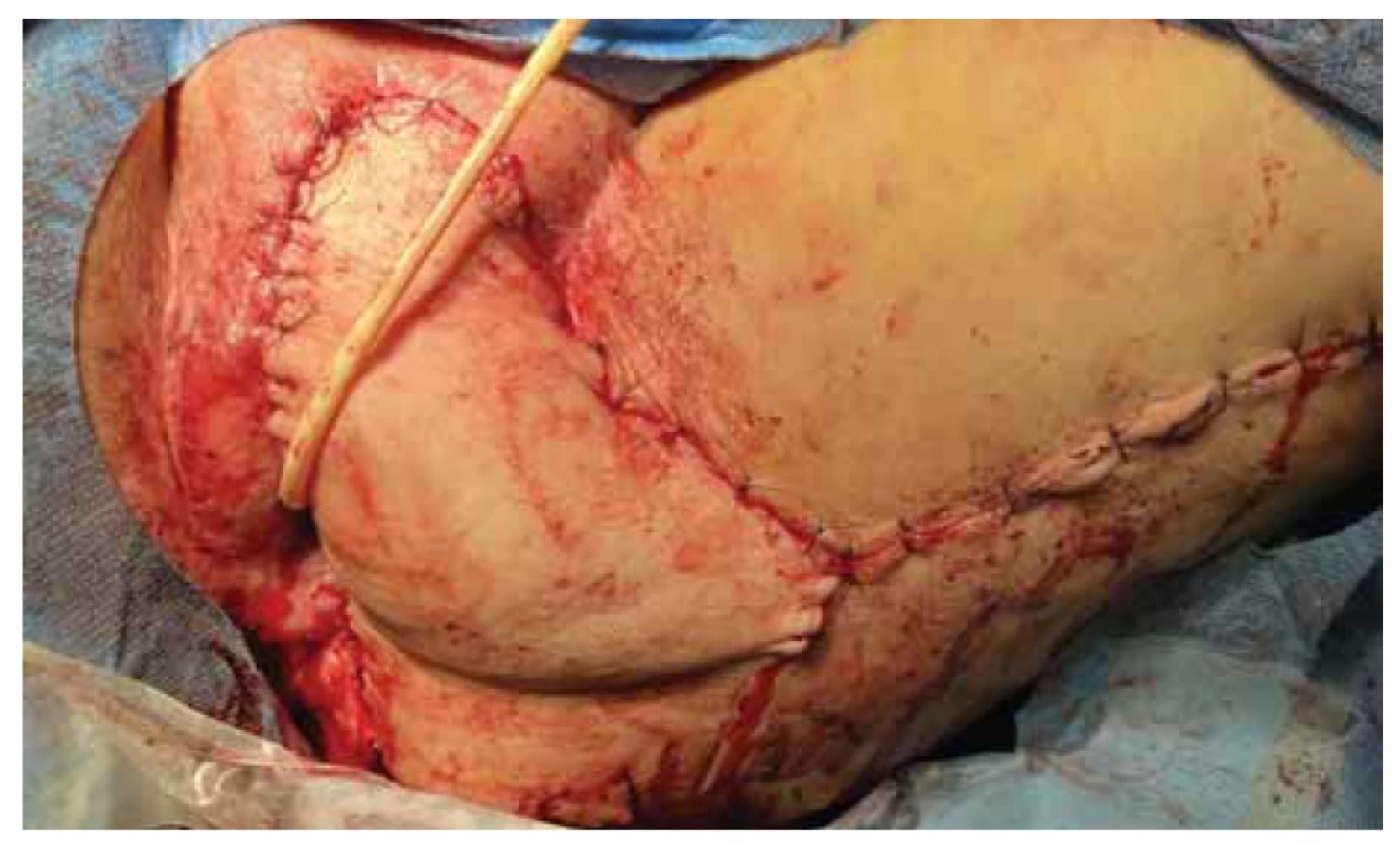 Laloková plastika – „posterior thigh flap“ po výkonu.<br>
Fig. 1. Vulvar reconstruction with “posterior thigh flap”.