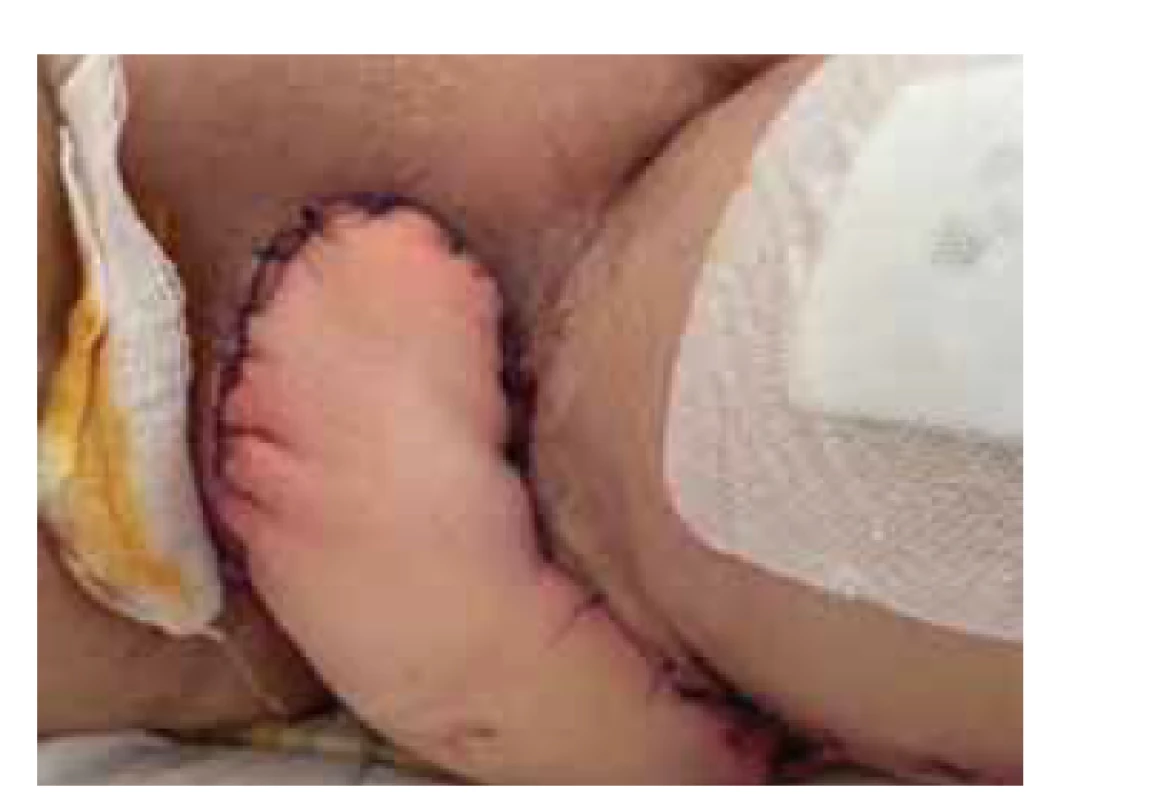 Laloková plastika – „posterior
thigh flap“ s odstupem 10 dnů po
výkonu.<br>
Fig. 2. Vulvar reconstruction with
“posterior thigh flap”; 10 days after
operation.
