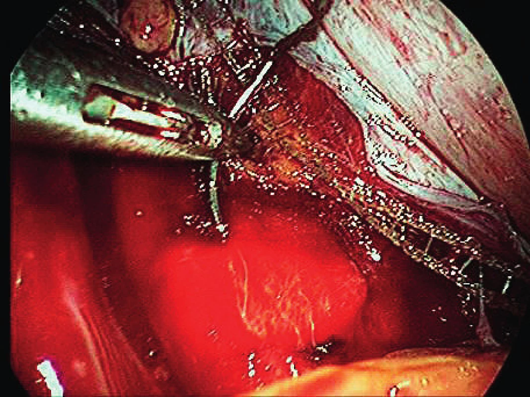 Implant fixation on sacrum