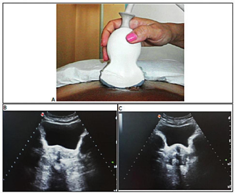 Abdominálny 2D USG v kľude a počas kontrakcie svalov