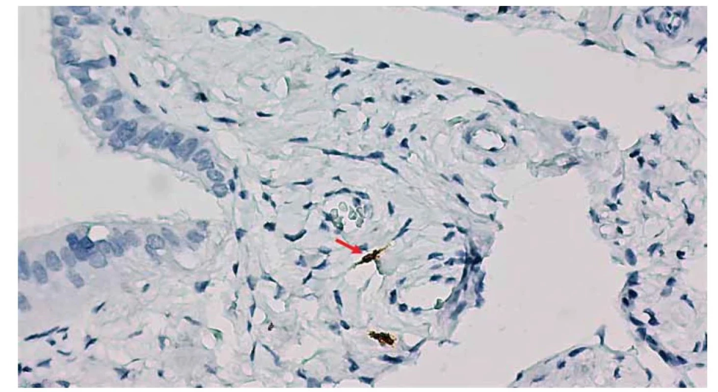 Detail väzivovej vrstvy sliznice. Imunohistochemický dôkaz prítomnosti novoobjavených intersticiálnych
buniek – telocytov prostredníctvom antigénu CD117 (červená šipka).<br>
Fig. 6. Detail of the fibrous layer of the mucous membrane. Immunohistochemical proof of the presence of newly discovered
interstitial cells – telocytes through CD117 antigen (red arrow).