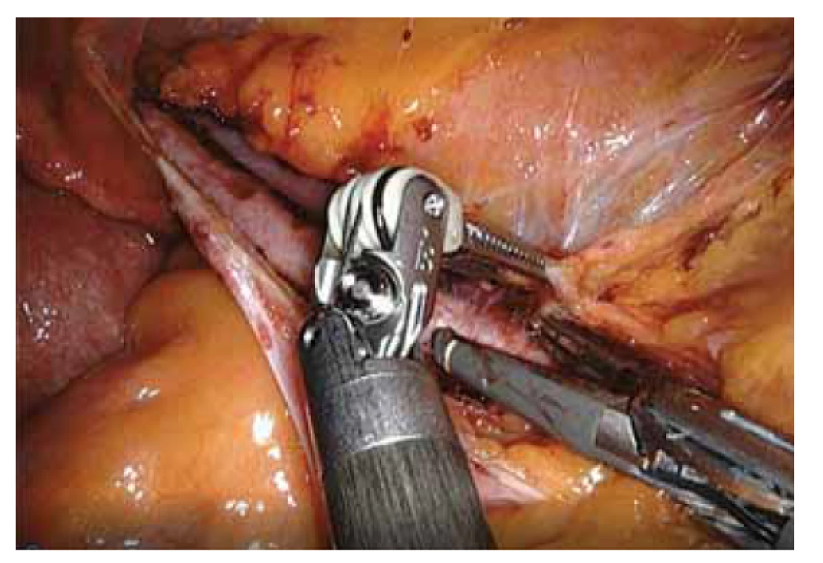 Ilustrační foto z pánevní robotem asistované laparoskopické
lymfadenektomie s využitím Vessel sealeru.<br>
Fig. 2. Illustration photo from pelvic robot-assisted laparoscopic
lymphadenectomy using a Vessel sealer.