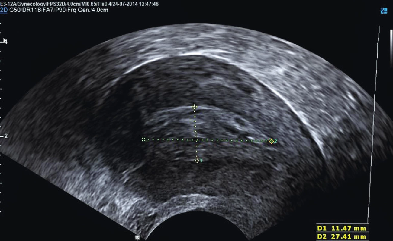 Karcinom děložního těla bez invaze do myometria
(FIGO IA)