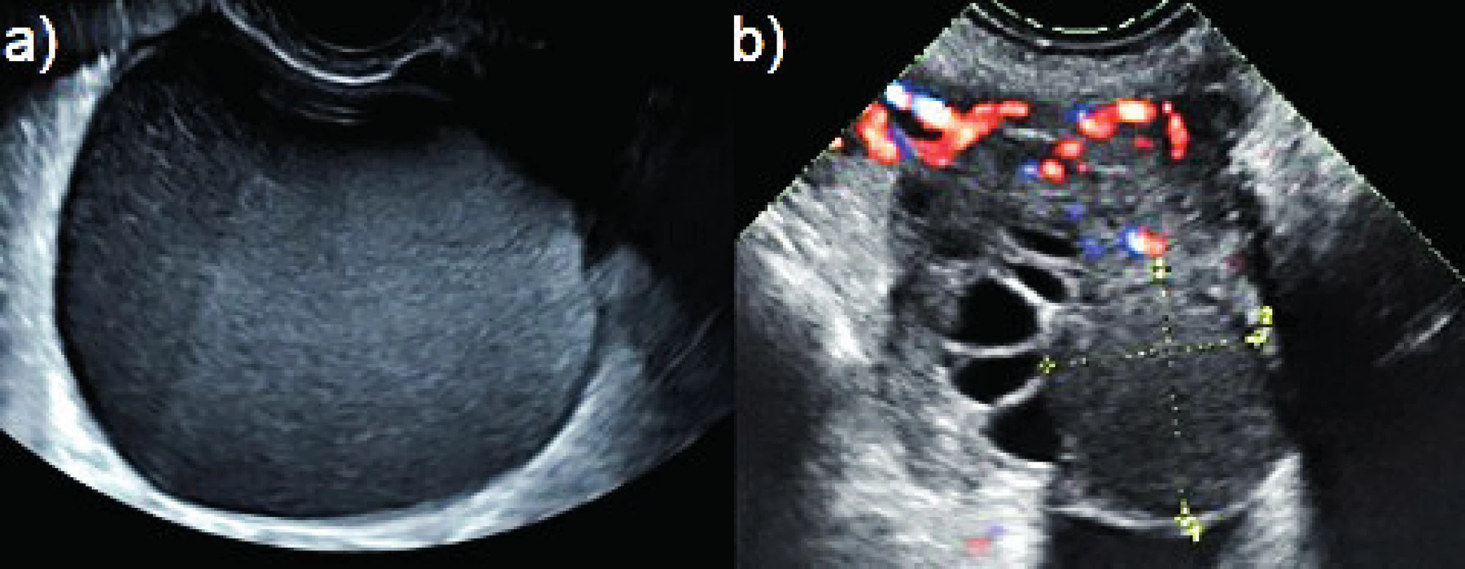 Typické endometroidní cysty<br>
(a) unilokulární hladkostěnná cysta s obsahem vzhledu mléčného
skla bez intraluminálních prominencí, bez přítomnosti rezidua
normální ovariální tkáně; (b) intraovariálně uložená endometroidní
cysta (přerušované čáry) bez vaskularizace ve stěně, obklopená
reziduální ovariální tkání.
