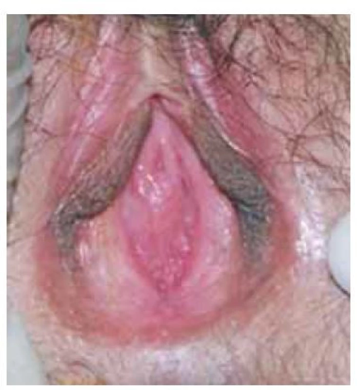 Vzhled genitálu u distální vaginální
ageneze.<br>
Fig. 1. Genital appearance in distal vaginal
agenesis.