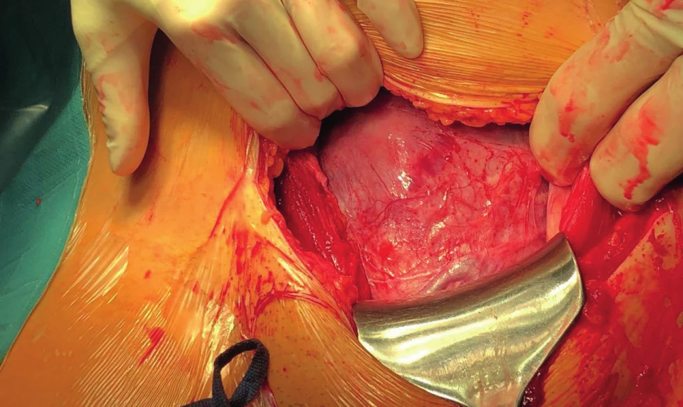 Peroperační nález dolního děložního segmentu při třetím císařském řezu

