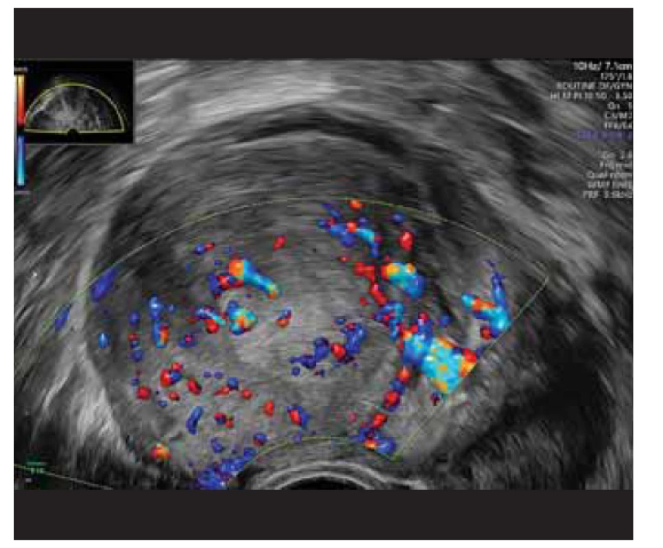 Ultrazvukový nález subserózní myomu s výraznějším
prokrvením, barevná škála 3.<br>
Fig. 2. Ultrasound finding of subserous fibroids with more
pronounced blood supply, color scale 3.