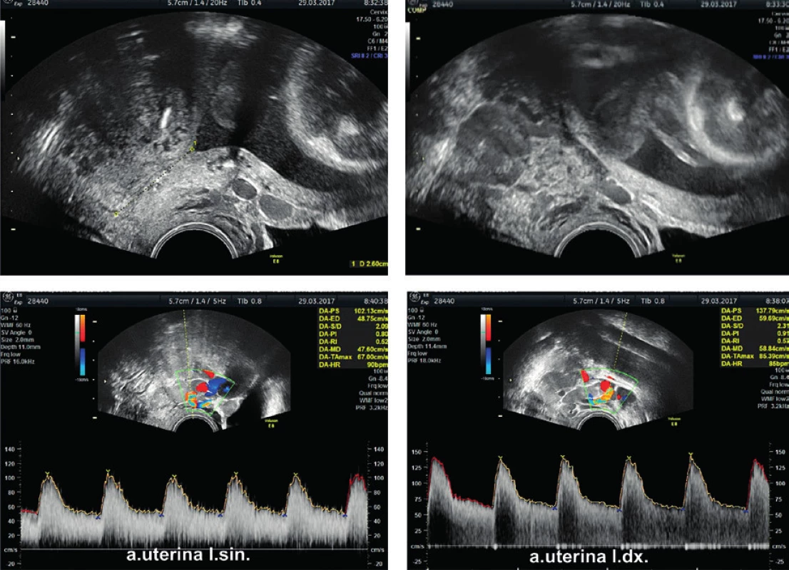 Cervical length measurement at 25 week’s gestation
and blood flow verification by dopplerometry in both uterine
arteries