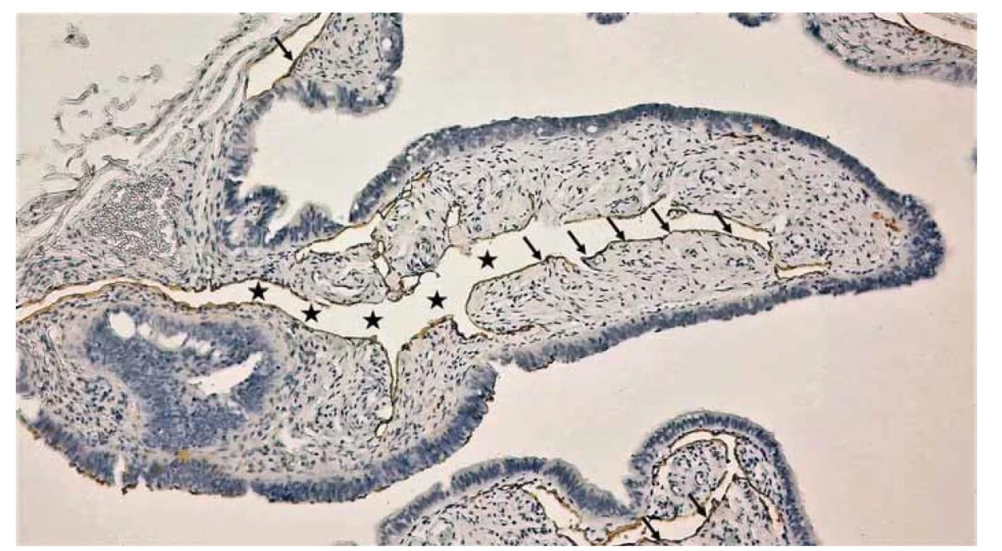 Detail slizničnej riasy ampully vajíčkovodu. Imunohistochemický dôkaz širokých lymfatických lakún vo väzivovej
vrstve sliznice. Lúmen lymfatických lakún (čierne hviezdy), diaminobenzidínom do hneda zafarbené lymfatické endotelové
bunky (čierne šípky) – dôkaz prítomnosti antigénu podoplanínu prostredníctvom protilátky D2-40.<br>
Fig. 5. Detail of the mucous alga of the ampulla of the fallopian tube. Immunohistochemical evidence of wide lymphatic lacunae
in the connective tissue layer of the mucosa. Lumen of lymphatic lacunae (black stars), diaminobenzidine brownstained
lymphatic endothelial cells (black arrows) – proof of the presence of podoplanin antigen via D2-40 antibody.