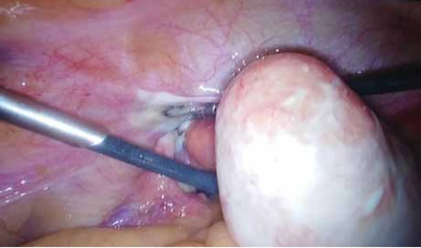 Peroperační nález myomu před laparoskopickou operací.<br>
Fig. 5. Perioperative finding of fibroids before laparoscopic surgery