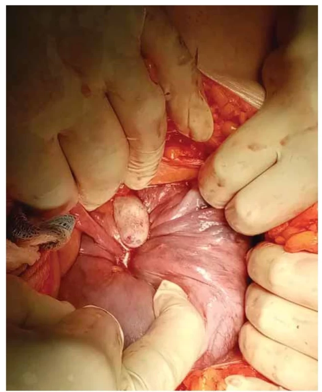 Inverze děložního fundu, perioperační foto (zdroj: archiv autorů).<br>
Fig. 1. Inversion of the uterine fundus, perioperative photo (source: authors’ archive).